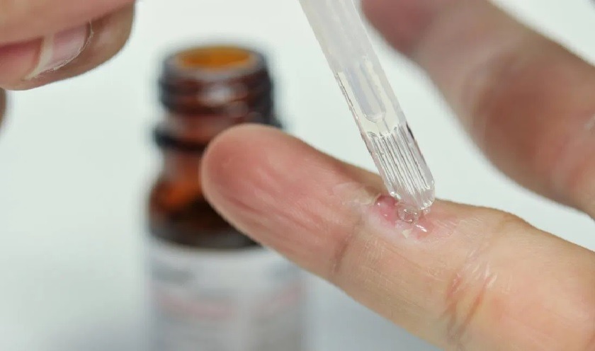 درمان زگیل ویروس HPV